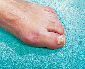 Aangedane nagel voor de nagelcorrectie